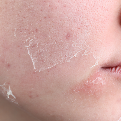 Close-up of a person's face with dry skin.
