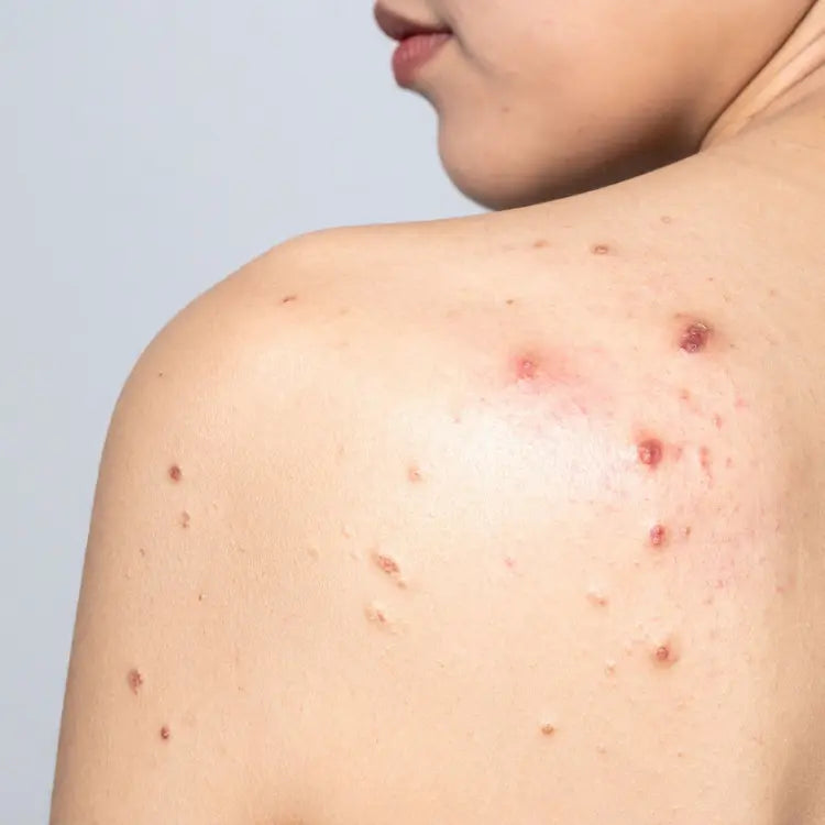 How to Treat Body Acne Naturally and Effectively at Home