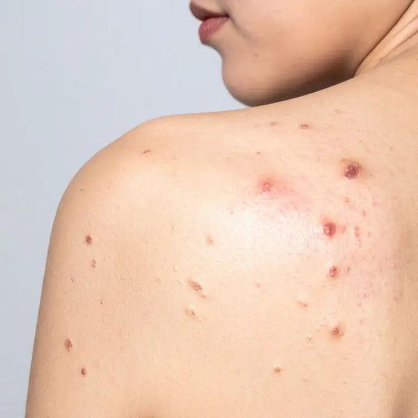 Glutathione Soap: Benefits, Safety, Results & Is It Worth the Hype? Bubblez Cosmetics Glutathione Soap: Benefits, Safety, Results & Is It Worth the Hype? Bubblez Cosmetics