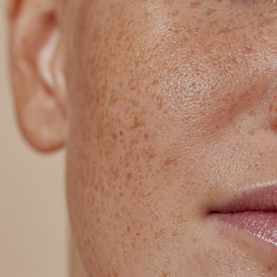 Close-up of a person's face with visible skin texture and pigmentation.