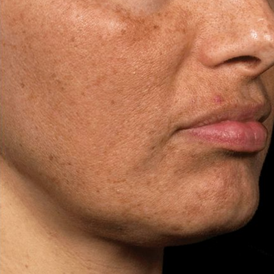 Close-up of a person's face with visible skin texture with tan.